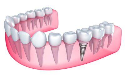 What are Dental Implants